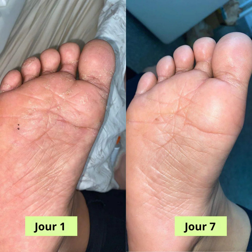 Savon Purifiant Antifongique