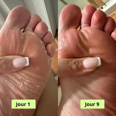 Savon Purifiant Antifongique