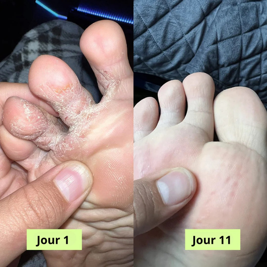 Savon Purifiant Antifongique
